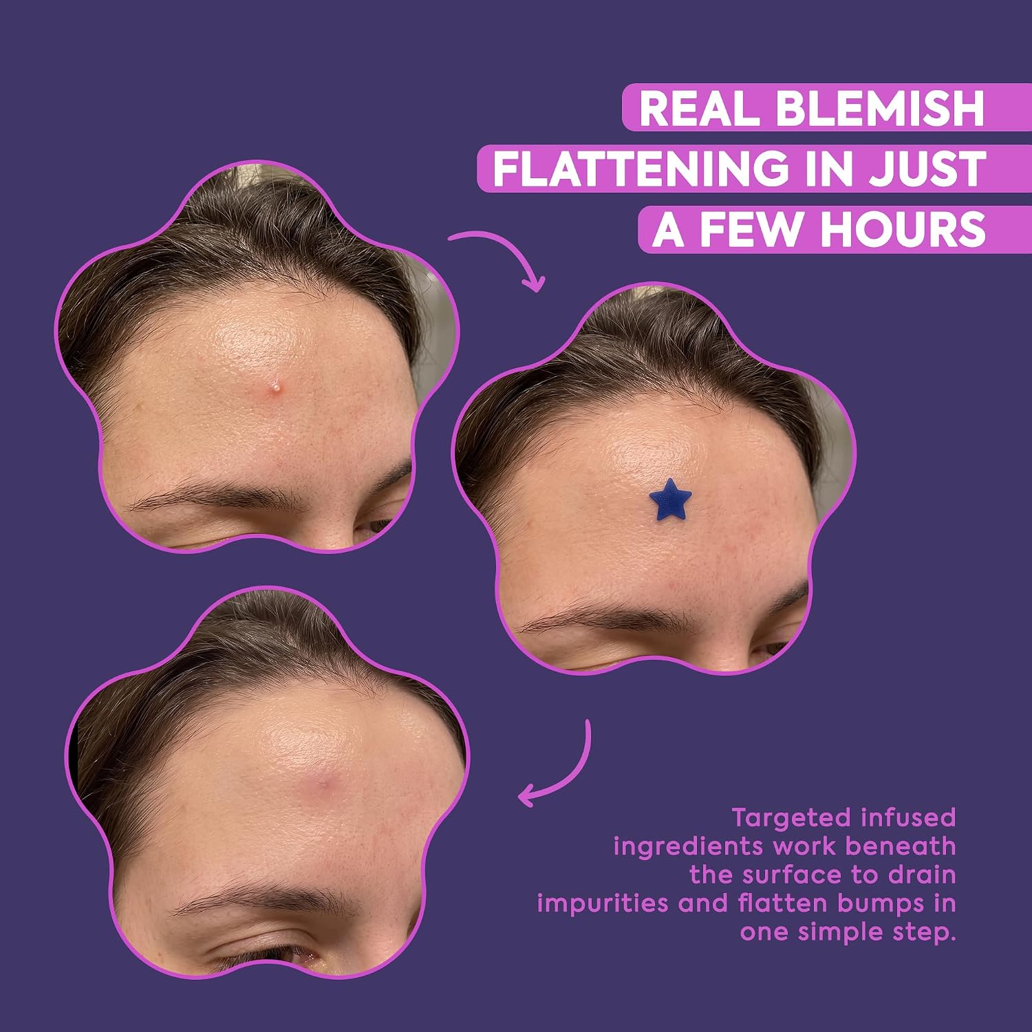 Livaclean 240CT Star Pimple Patches for Face w/ Hydrocolloid, Tea Tree oil & Salicylic Acid - Zit Stickers, Hydrocolloid Acne Patches for Face - Cute Pimple Patch, Acne Stickers - Image 7